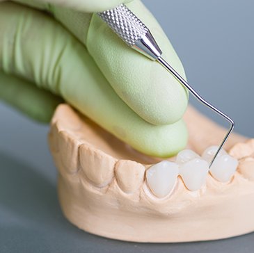 Dentist pointing to model of dental bridge