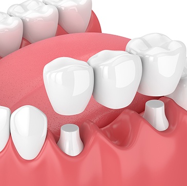 Illustration of dental bridge being placed on bottom teeth