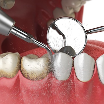 Illustration of dental cleaning