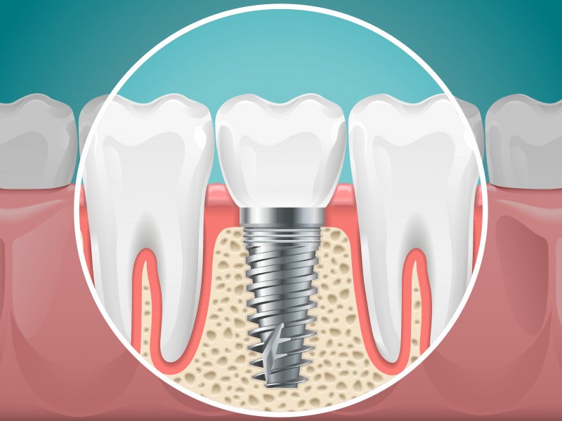 How Long Do Dental Implants Last Waco Dental Implants